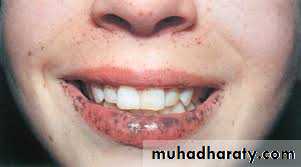 pigmented lesion of oral mucosa
