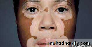 pigmented lesion of oral mucosa