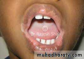 pigmented lesion of oral mucosa