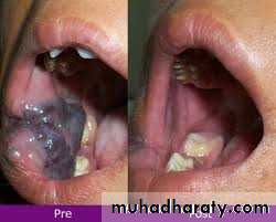 pigmented lesion of oral mucosa