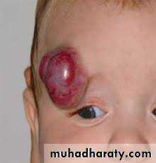 pigmented lesion of oral mucosa