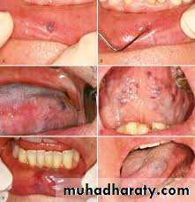 pigmented lesion of oral mucosa