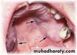 pigmented lesion of oral mucosa