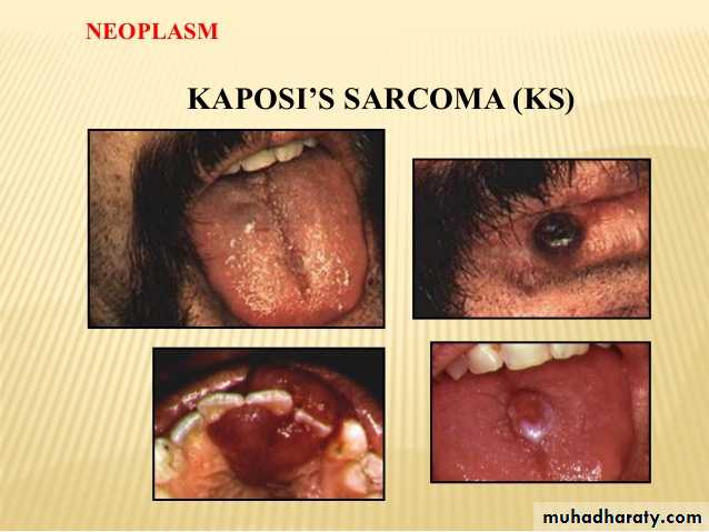 pigmented lesion of oral mucosa