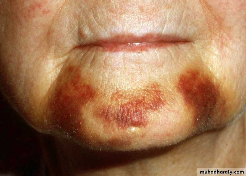 pigmented lesion of oral mucosa