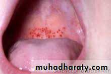 pigmented lesion of oral mucosa