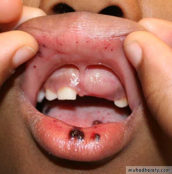 pigmented lesion of oral mucosa