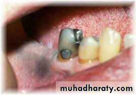 pigmented lesion of oral mucosa