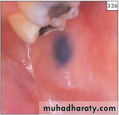 pigmented lesion of oral mucosa