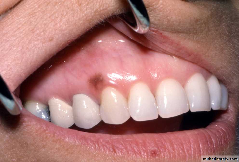 pigmented lesion of oral mucosa