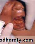 pigmented lesion of oral mucosa