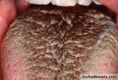 pigmented lesion of oral mucosa