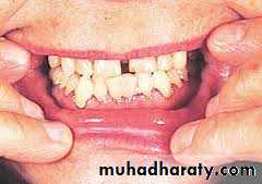 pigmented lesion of oral mucosa