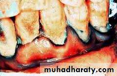 pigmented lesion of oral mucosa
