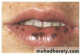 pigmented lesion of oral mucosa