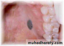 pigmented lesion of oral mucosa