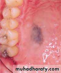 pigmented lesion of oral mucosa