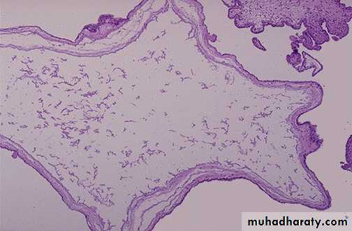 Gestational trophoblastic disease