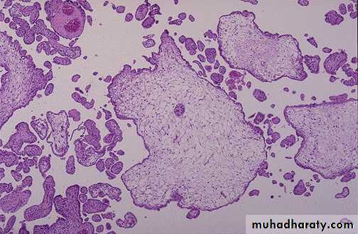 Gestational trophoblastic disease