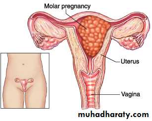 Gestational trophoblastic disease