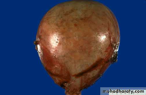 Gestational trophoblastic disease