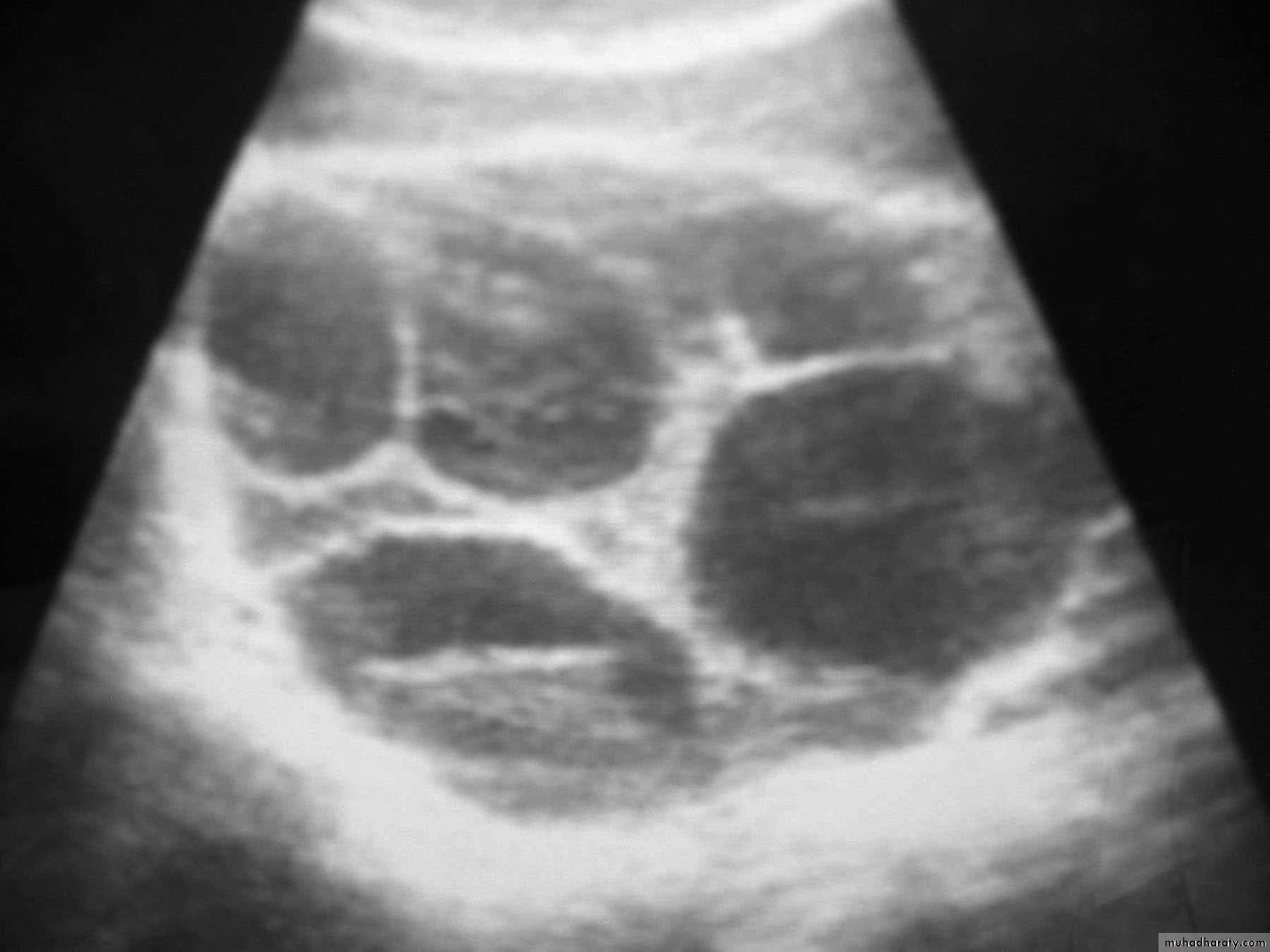 Gestational trophoblastic disease