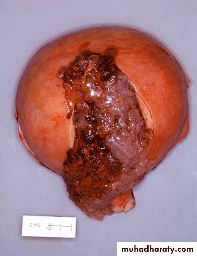 Gestational trophoblastic disease