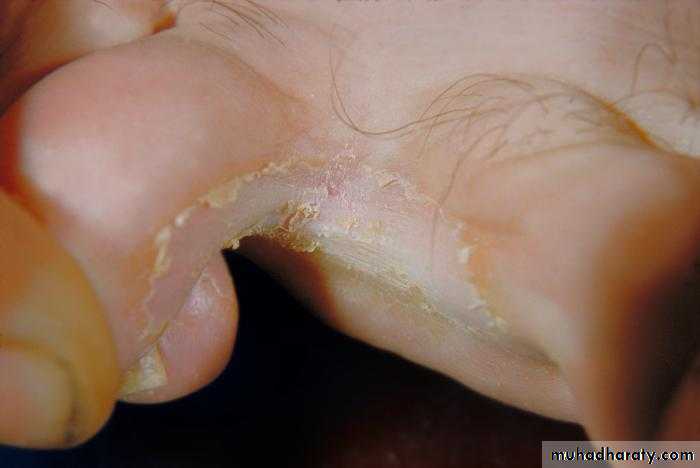 fungal infection