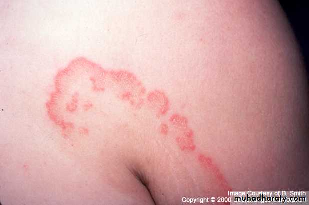 fungal infection