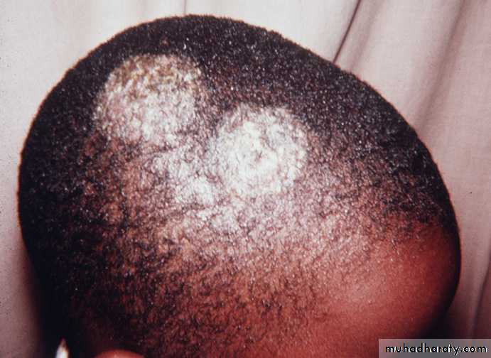 fungal infection