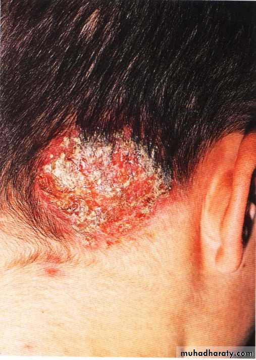 fungal infection