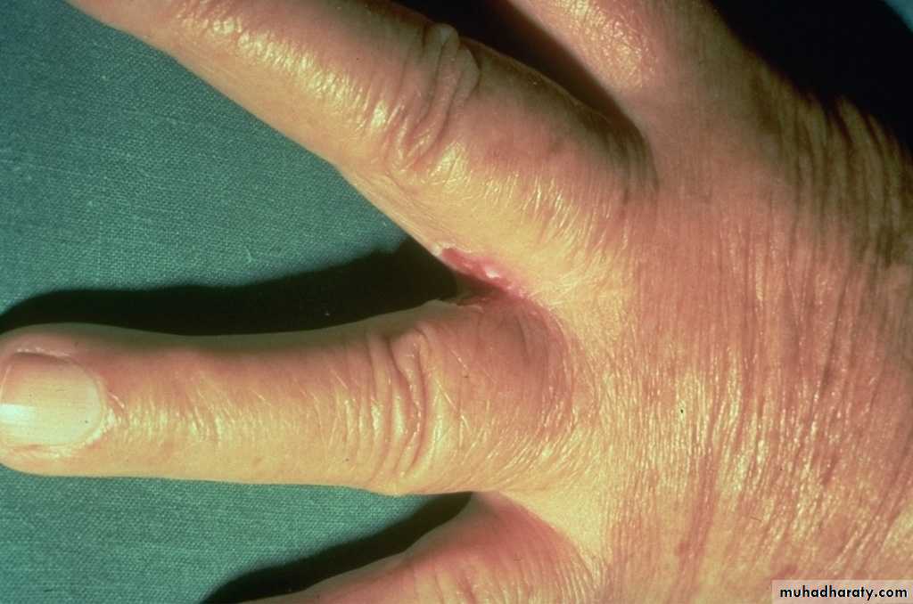 fungal infection