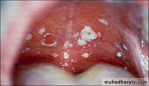 fungal infection