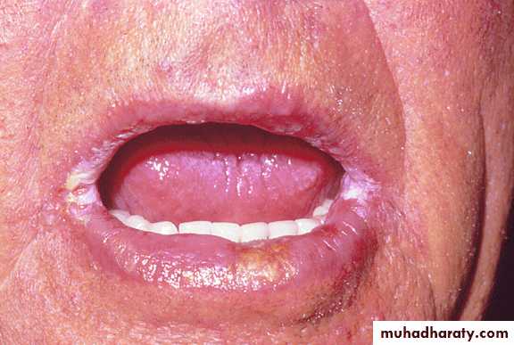 fungal infection