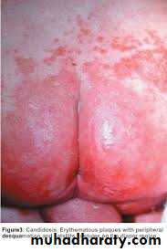 fungal infection