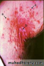 fungal infection