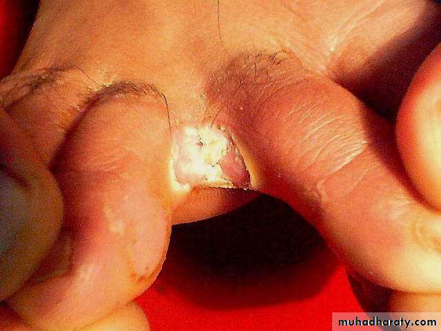 fungal infection