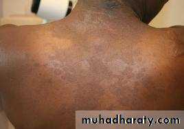 fungal infection