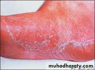 fungal infection