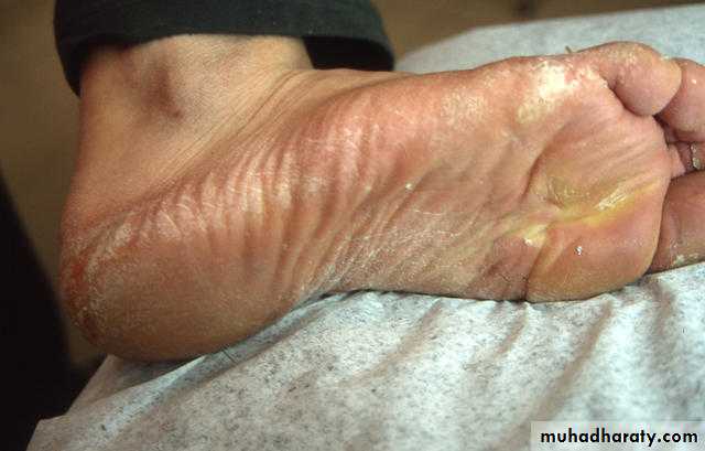 fungal infection