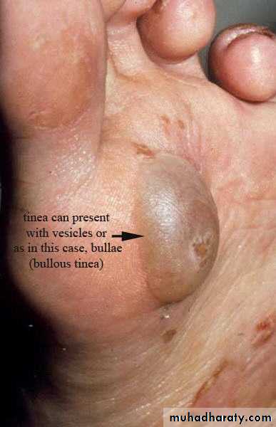 fungal infection