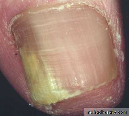 fungal infection