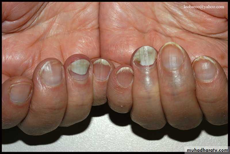 fungal infection