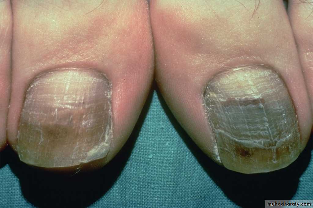 fungal infection