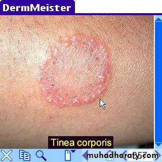 fungal infection