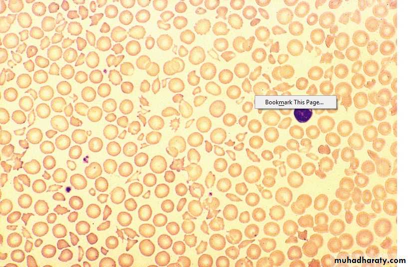 1.Thrombotic thrombocytopenic purpura