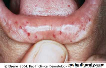 1.Thrombotic thrombocytopenic purpura