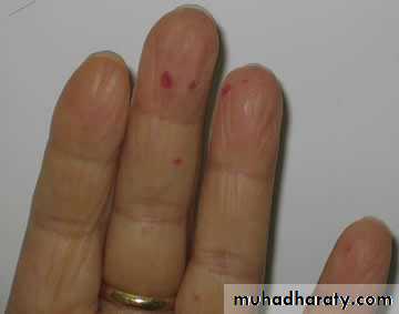 1.Thrombotic thrombocytopenic purpura