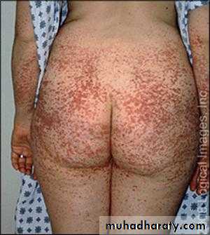 1.Thrombotic thrombocytopenic purpura