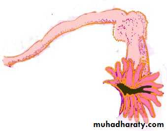 Treatment of Ectopic pregnancy